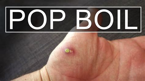 Disclaimer: Most doctors advice not to pop bumps. . Boil popping